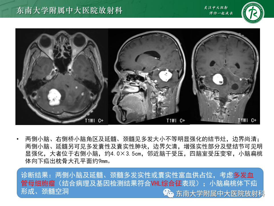 影像PPT - 【PPT】小脑血管母细胞瘤-17