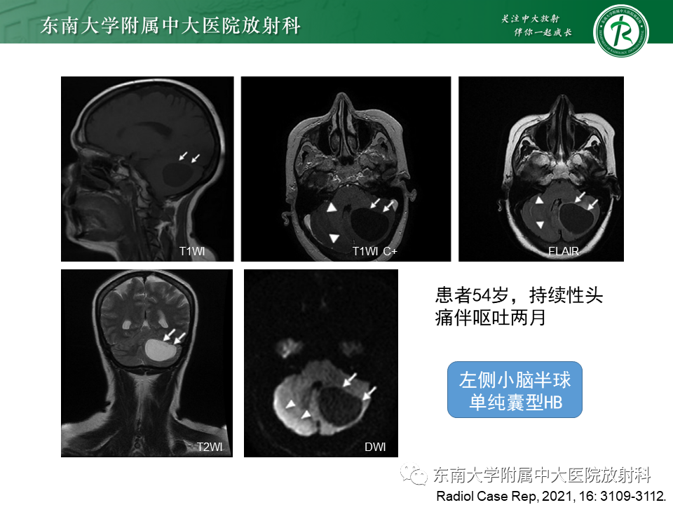 影像PPT - 【PPT】小脑血管母细胞瘤-15