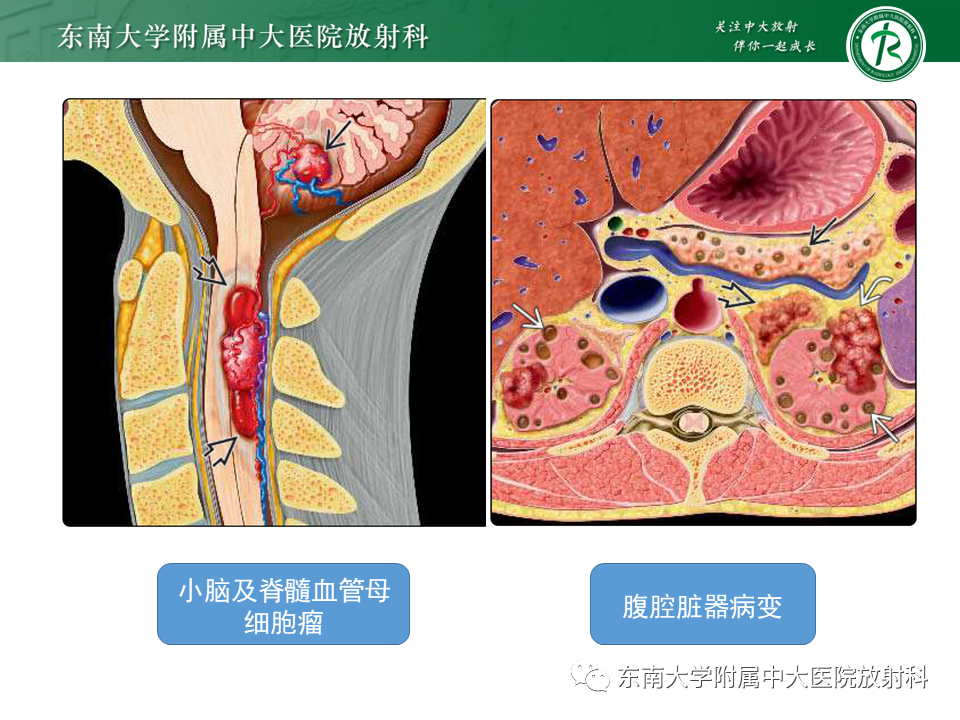 影像PPT - 【PPT】小脑血管母细胞瘤-19