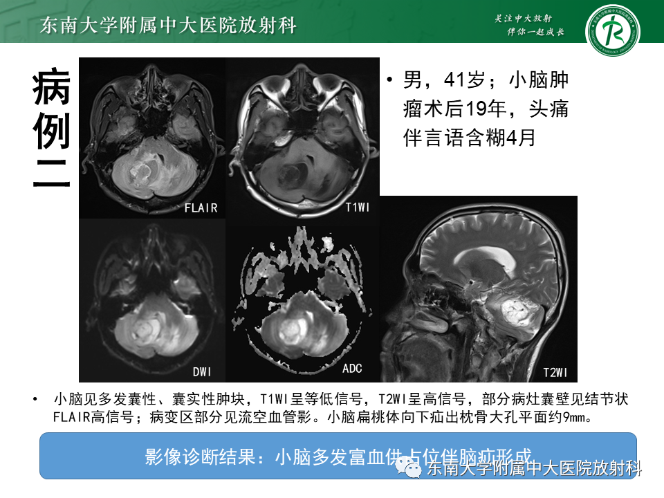 影像PPT - 【PPT】小脑血管母细胞瘤-16