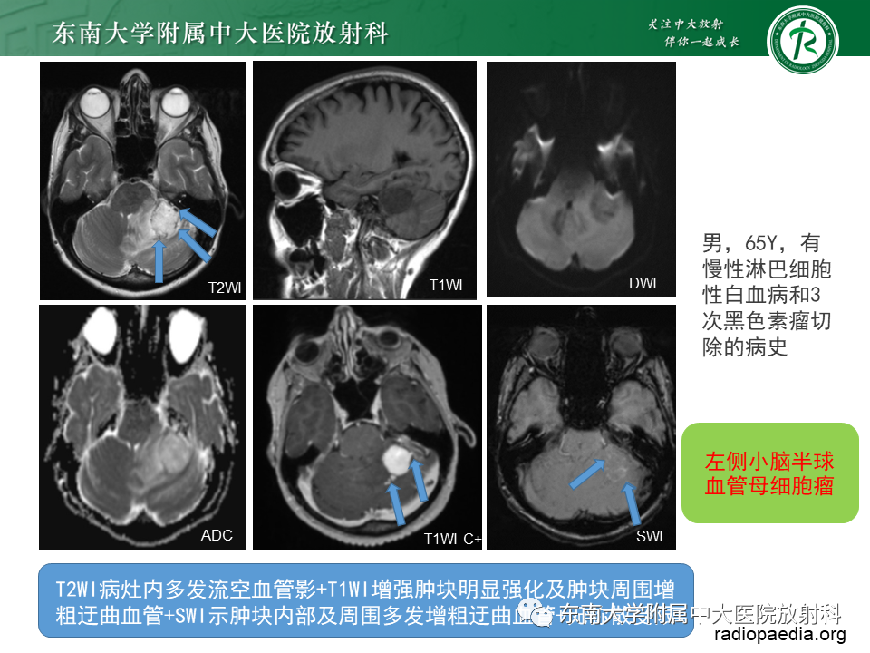 影像PPT - 【PPT】小脑血管母细胞瘤-13