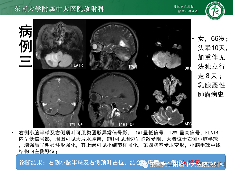 影像PPT - 【PPT】小脑血管母细胞瘤-20