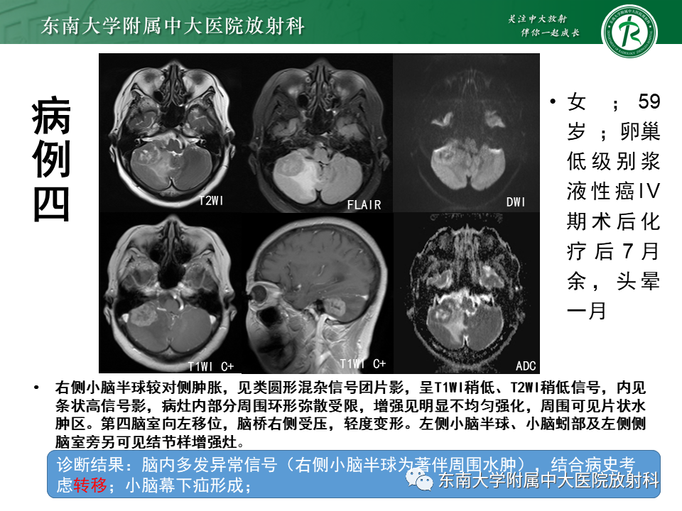 影像PPT - 【PPT】小脑血管母细胞瘤-23