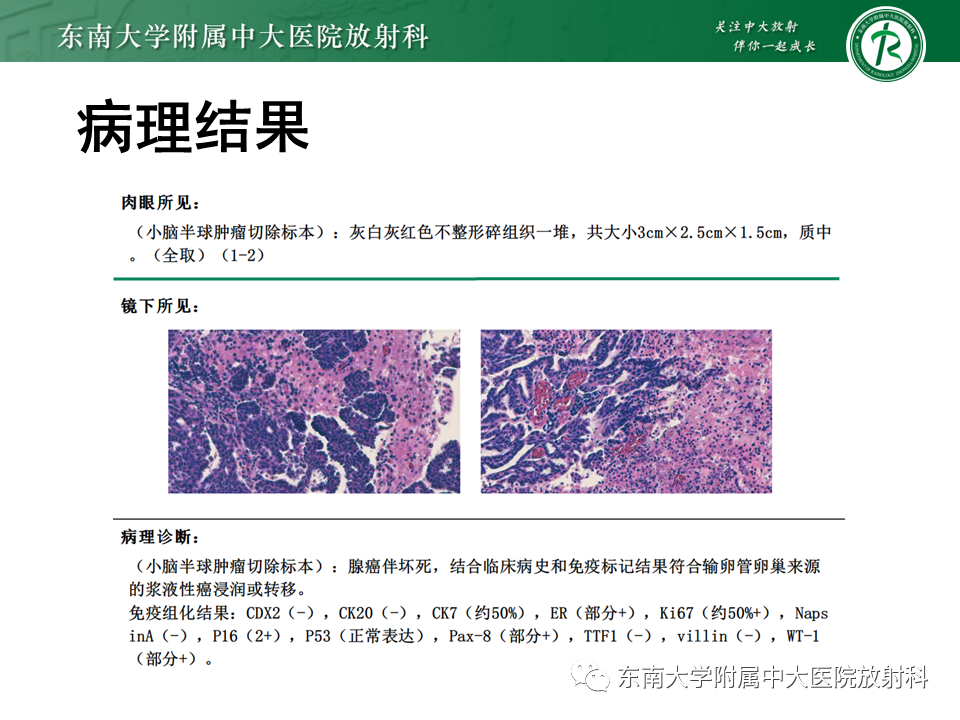 影像PPT - 【PPT】小脑血管母细胞瘤-24