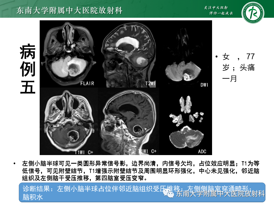 影像PPT - 【PPT】小脑血管母细胞瘤-28