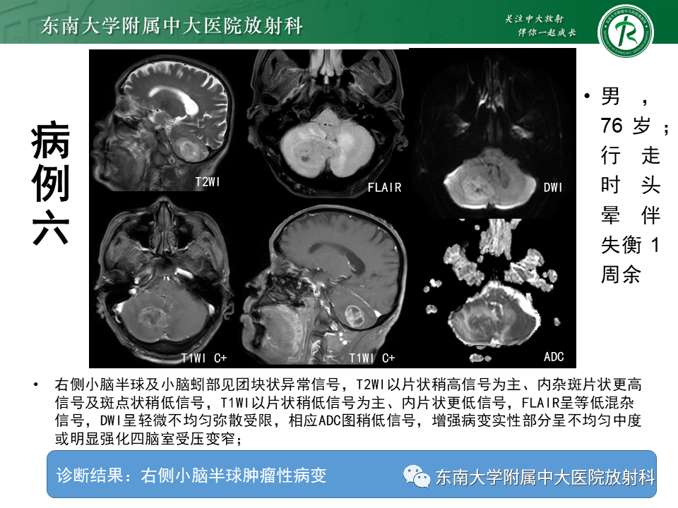 影像PPT - 【PPT】小脑血管母细胞瘤-31