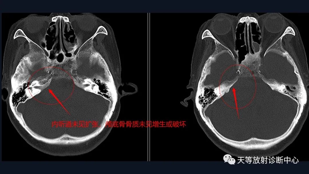 影像PPT - 【病例】颅内占位性病变1例波谱分析-5 影像PPT - 【病例】颅内占位性病变1例波谱分析-5