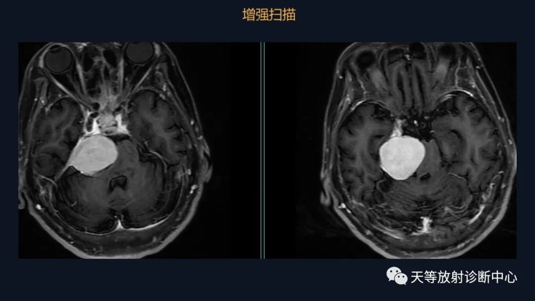影像PPT - 【病例】颅内占位性病变1例波谱分析-16 影像PPT - 【病例】颅内占位性病变1例波谱分析-16