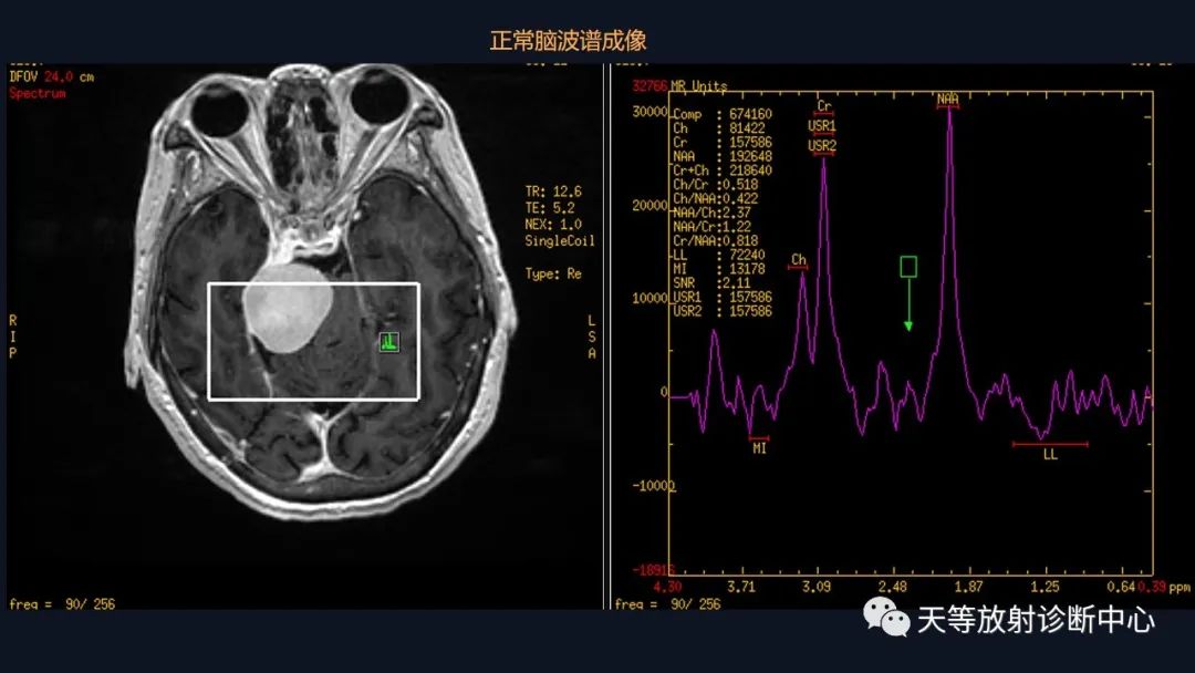 影像PPT - 【病例】颅内占位性病变1例波谱分析-27 影像PPT - 【病例】颅内占位性病变1例波谱分析-27