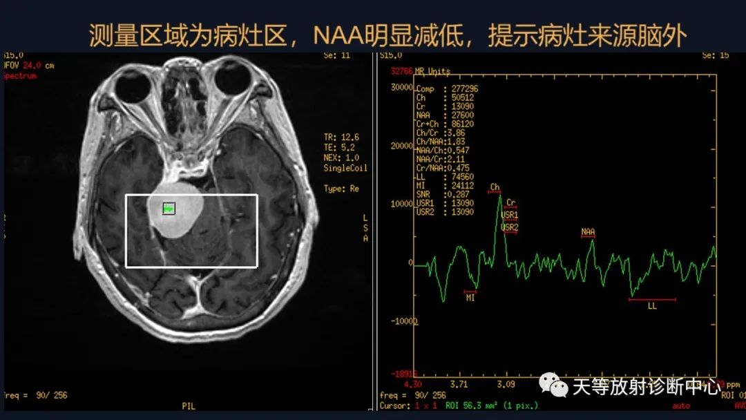 影像PPT - 【病例】颅内占位性病变1例波谱分析-29 影像PPT - 【病例】颅内占位性病变1例波谱分析-29