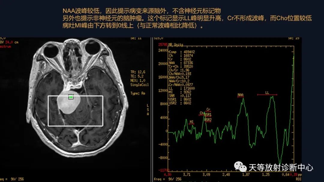 影像PPT - 【病例】颅内占位性病变1例波谱分析-30 影像PPT - 【病例】颅内占位性病变1例波谱分析-30