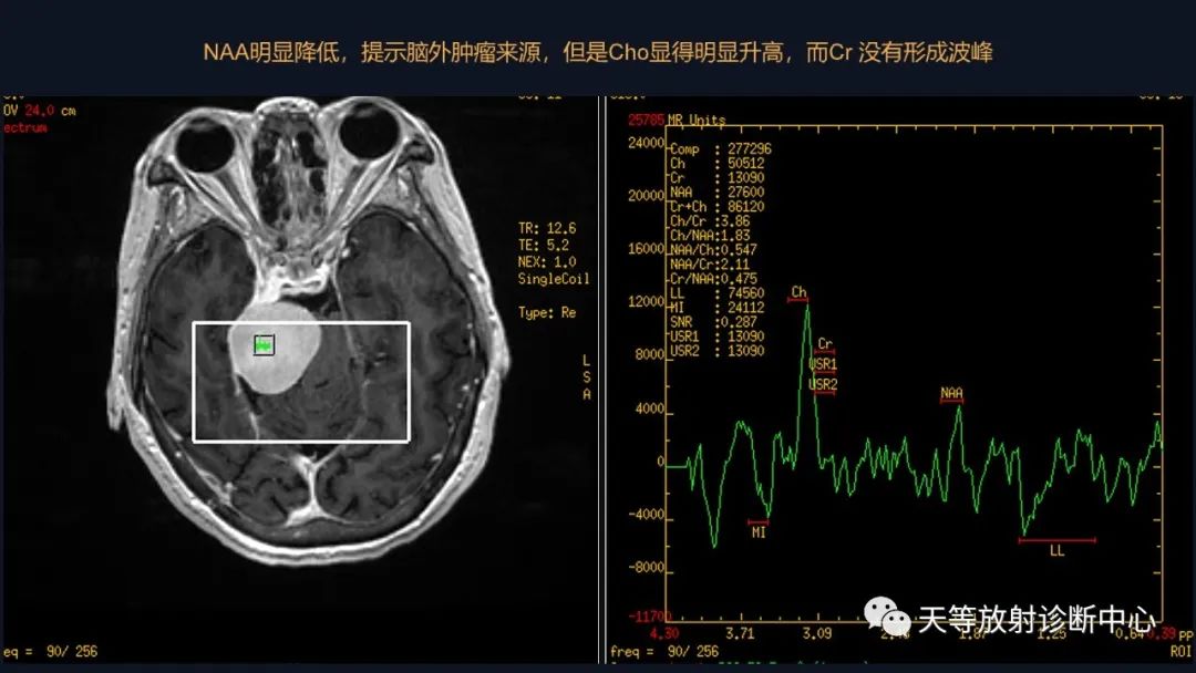 影像PPT - 【病例】颅内占位性病变1例波谱分析-31 影像PPT - 【病例】颅内占位性病变1例波谱分析-31