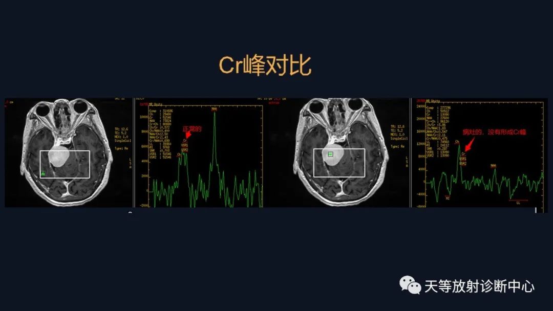 影像PPT - 【病例】颅内占位性病变1例波谱分析-35 影像PPT - 【病例】颅内占位性病变1例波谱分析-35