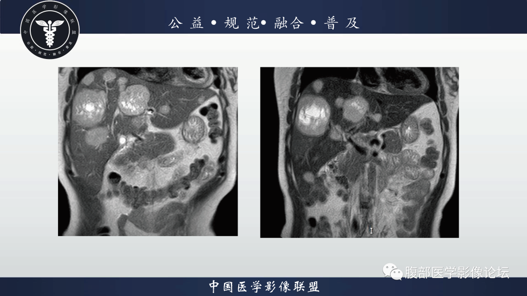 影像PPT - 【病例】胃窦神经内分泌肿瘤1例CT及MR影像-4