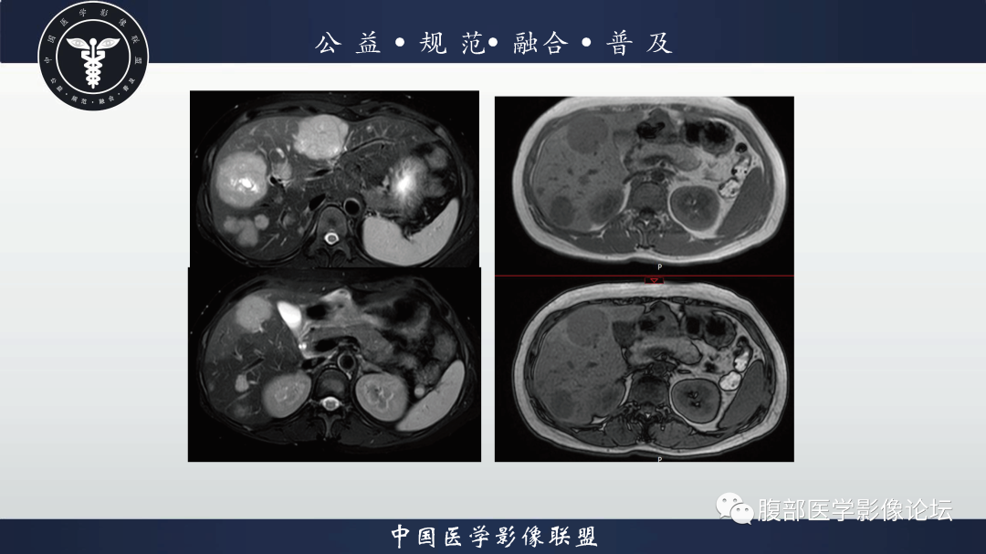 影像PPT - 【病例】胃窦神经内分泌肿瘤1例CT及MR影像-3