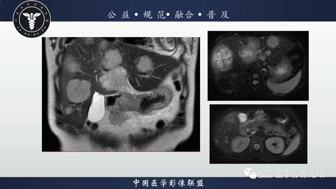 影像PPT - 【病例】胃窦神经内分泌肿瘤1例CT及MR影像-5