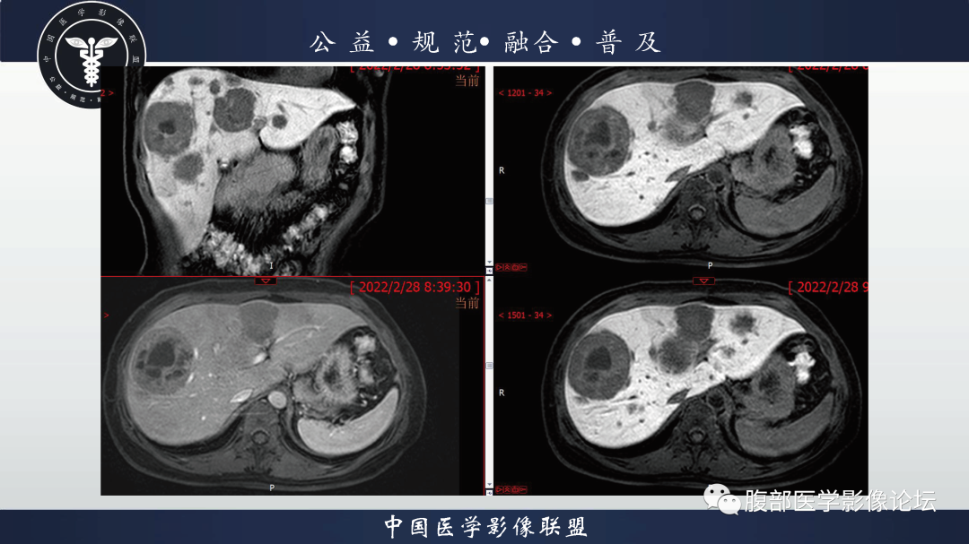 影像PPT - 【病例】胃窦神经内分泌肿瘤1例CT及MR影像-8