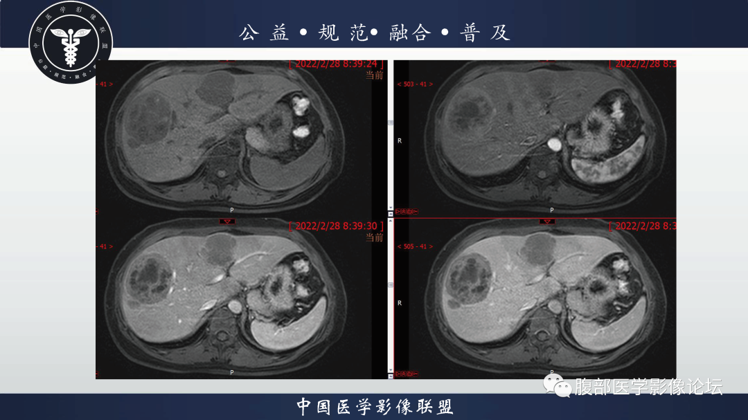 影像PPT - 【病例】胃窦神经内分泌肿瘤1例CT及MR影像-6