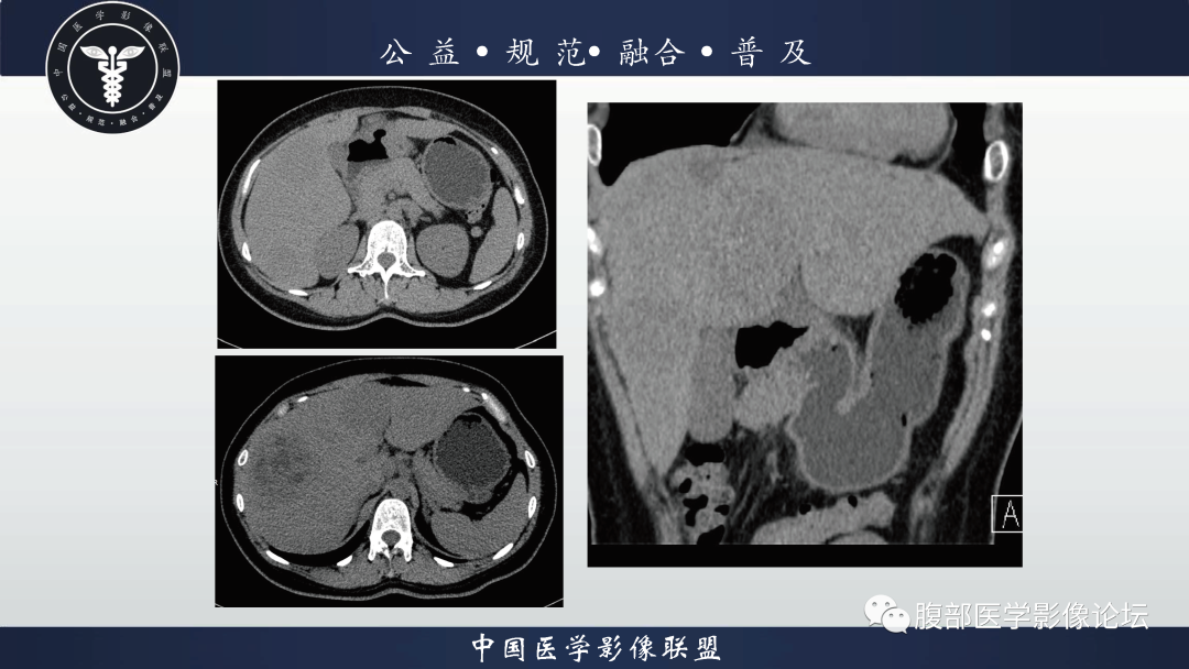 影像PPT - 【病例】胃窦神经内分泌肿瘤1例CT及MR影像-2