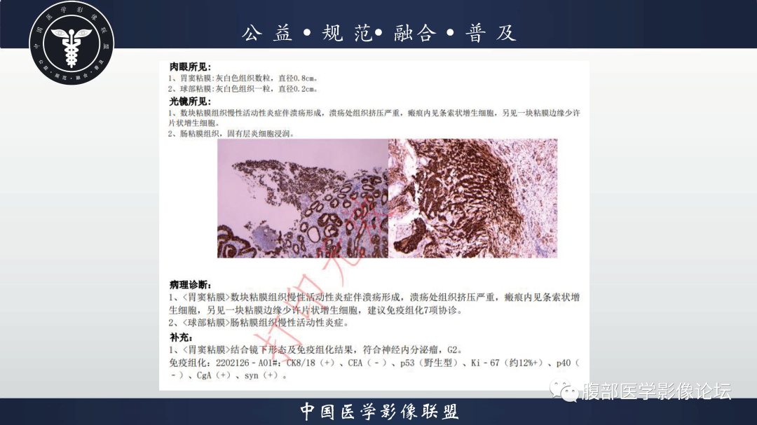 影像PPT - 【病例】胃窦神经内分泌肿瘤1例CT及MR影像-16