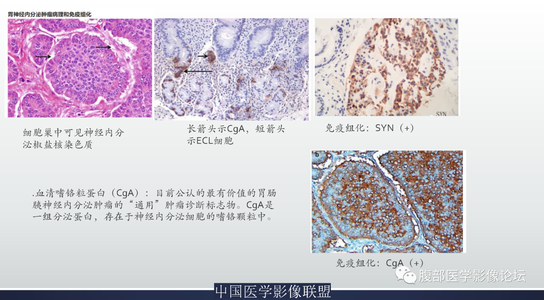 影像PPT - 【病例】胃窦神经内分泌肿瘤1例CT及MR影像-20