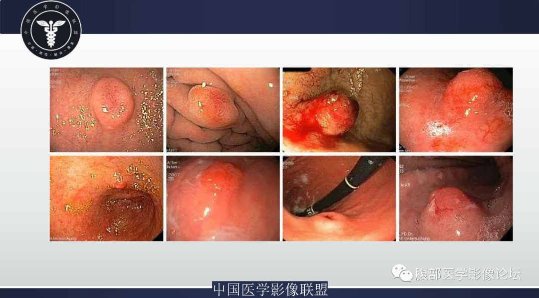影像PPT - 【病例】胃窦神经内分泌肿瘤1例CT及MR影像-19
