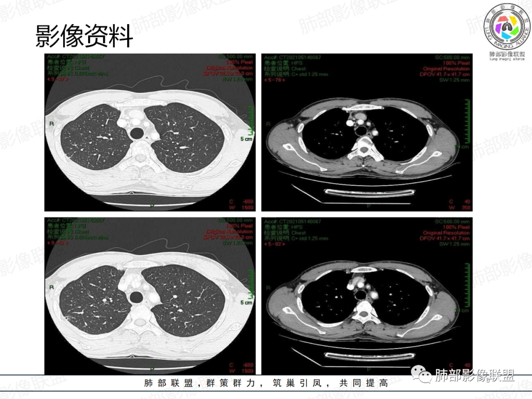 影像PPT - 【病例】楔形跨段病变1例CT影像分析思路-5 影像PPT - 【病例】楔形跨段病变1例CT影像分析思路-5