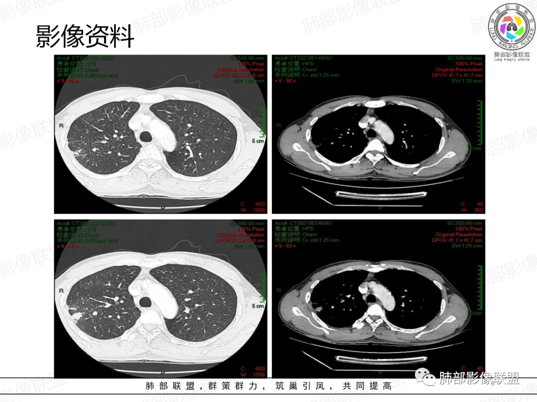 影像PPT - 【病例】楔形跨段病变1例CT影像分析思路-6 影像PPT - 【病例】楔形跨段病变1例CT影像分析思路-6