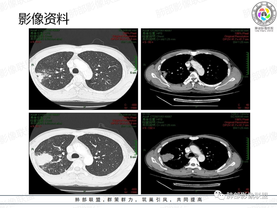 影像PPT - 【病例】楔形跨段病变1例CT影像分析思路-7 影像PPT - 【病例】楔形跨段病变1例CT影像分析思路-7