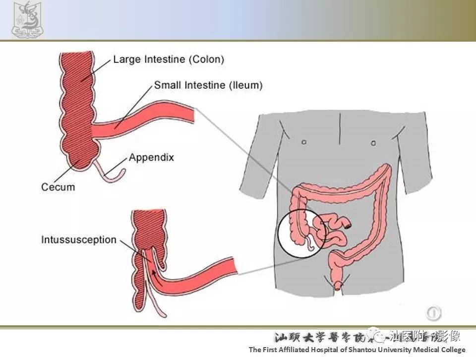 影像PPT - 【PPT】肠套叠影像学诊断-4