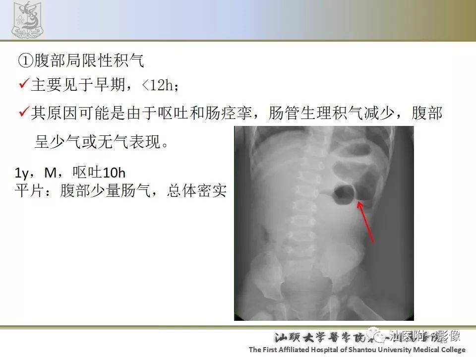 影像PPT - 【PPT】肠套叠影像学诊断-15
