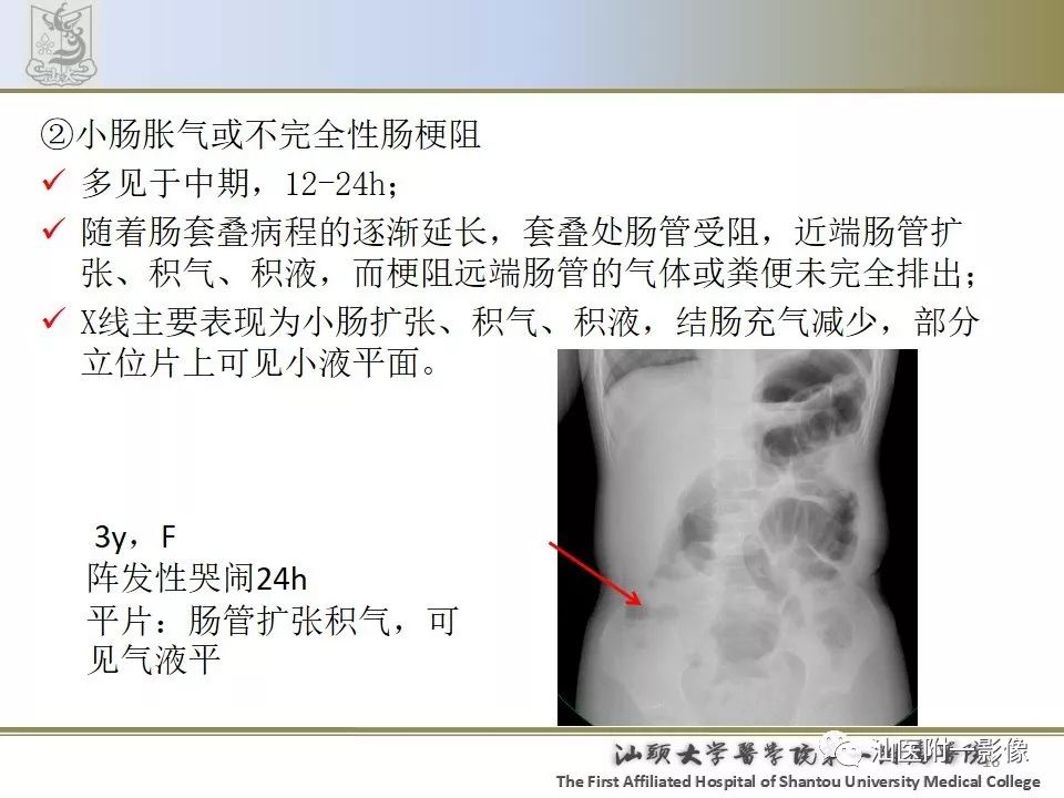 影像PPT - 【PPT】肠套叠影像学诊断-16