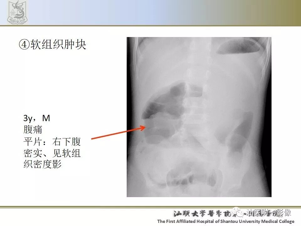 影像PPT - 【PPT】肠套叠影像学诊断-18