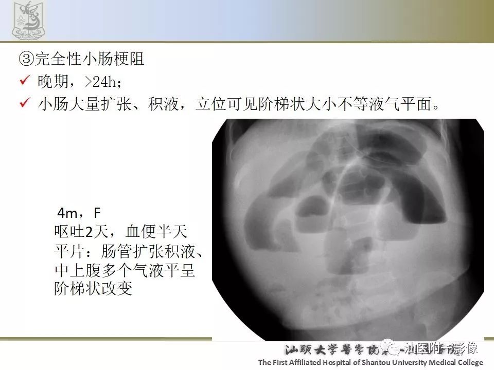 影像PPT - 【PPT】肠套叠影像学诊断-17