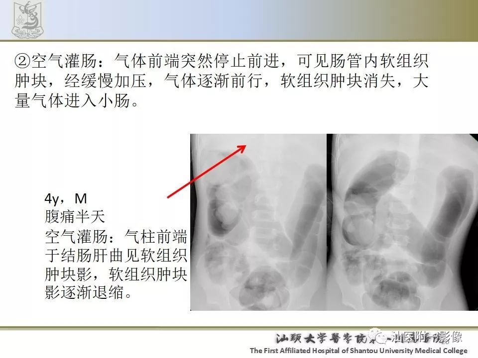 影像PPT - 【PPT】肠套叠影像学诊断-20