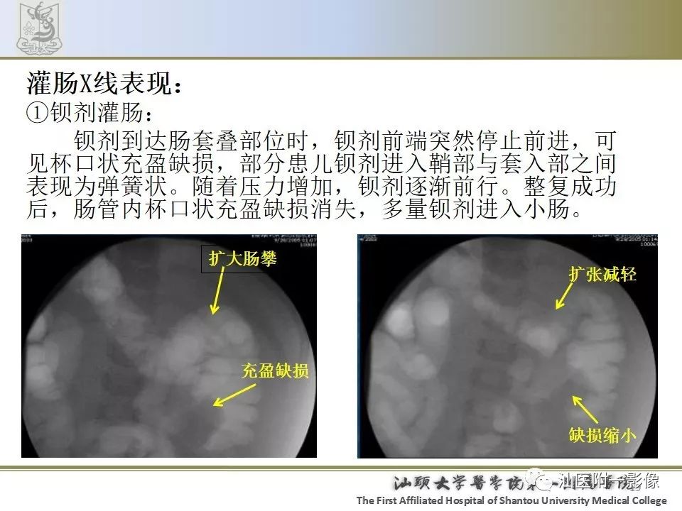 影像PPT - 【PPT】肠套叠影像学诊断-19