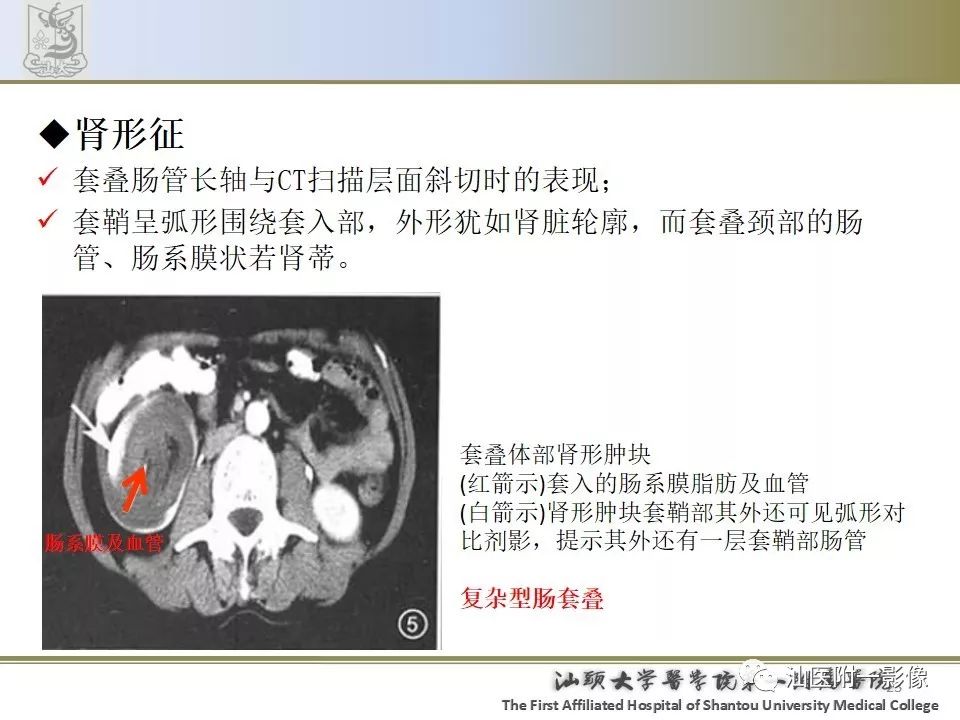 影像PPT - 【PPT】肠套叠影像学诊断-23