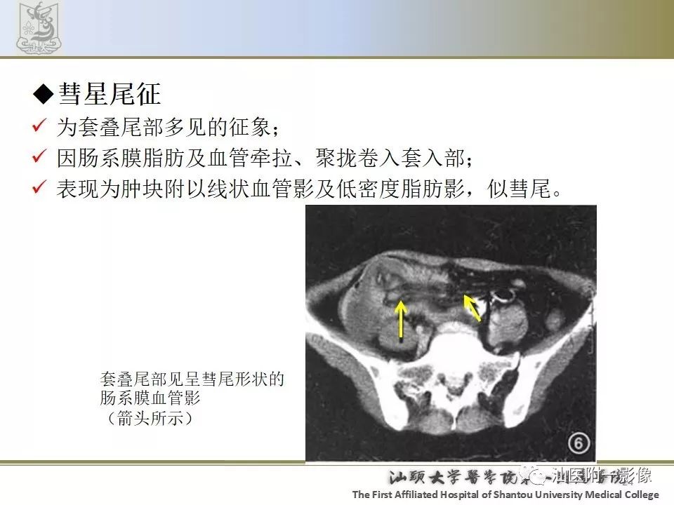 影像PPT - 【PPT】肠套叠影像学诊断-24