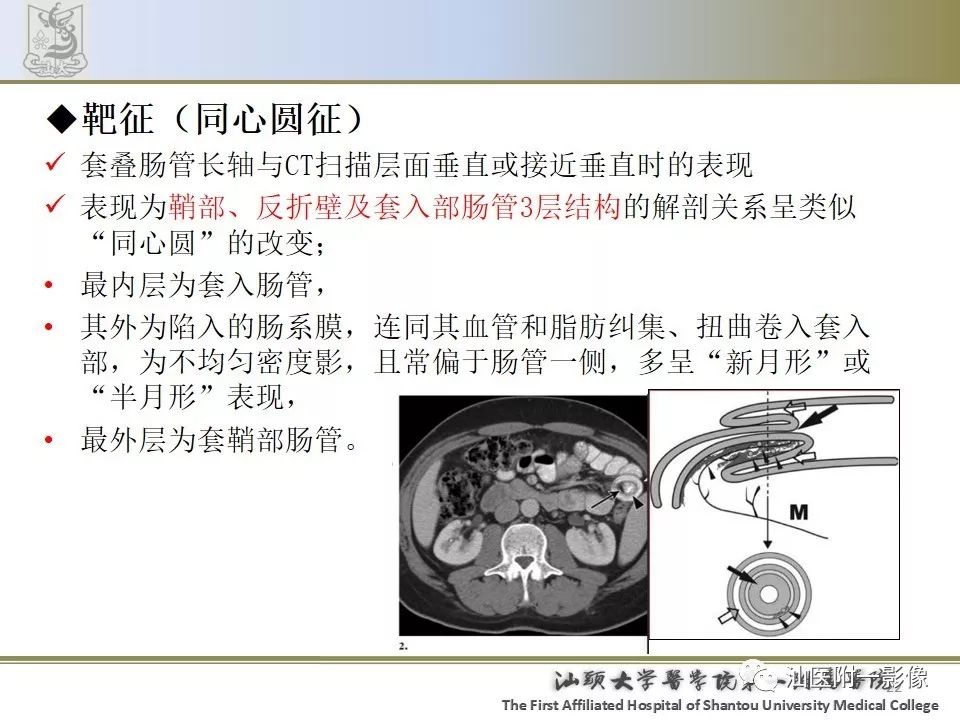 影像PPT - 【PPT】肠套叠影像学诊断-22