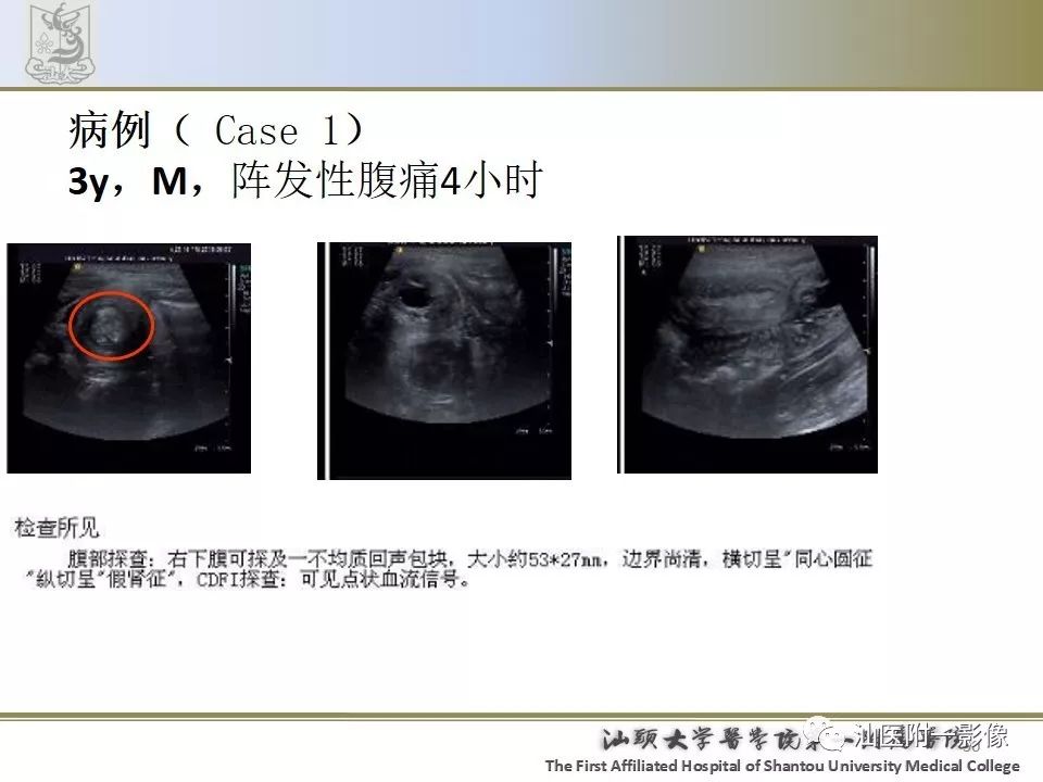 影像PPT - 【PPT】肠套叠影像学诊断-30
