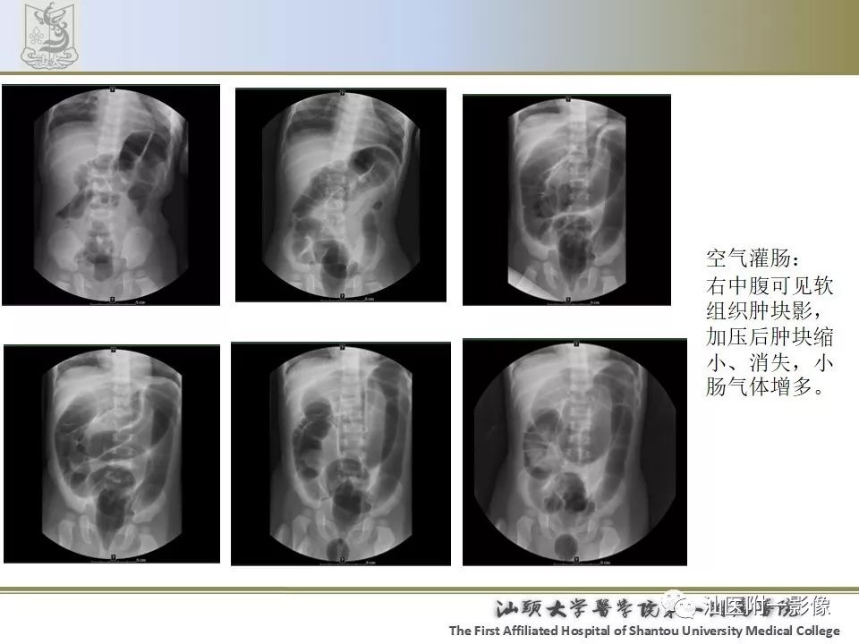 影像PPT - 【PPT】肠套叠影像学诊断-31