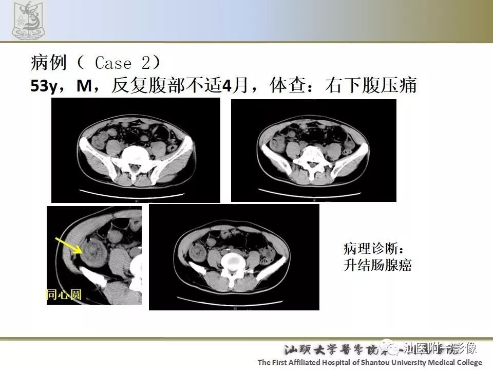 影像PPT - 【PPT】肠套叠影像学诊断-32
