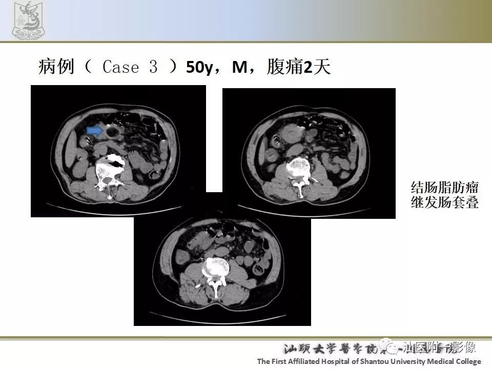 影像PPT - 【PPT】肠套叠影像学诊断-33