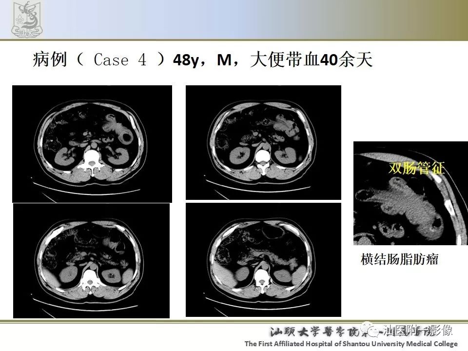 影像PPT - 【PPT】肠套叠影像学诊断-34