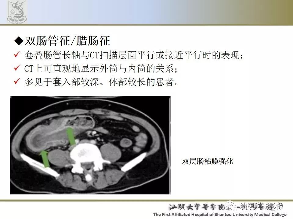 影像PPT - 【PPT】肠套叠影像学诊断-25