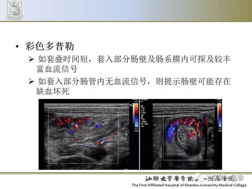 影像PPT - 【PPT】肠套叠影像学诊断-29