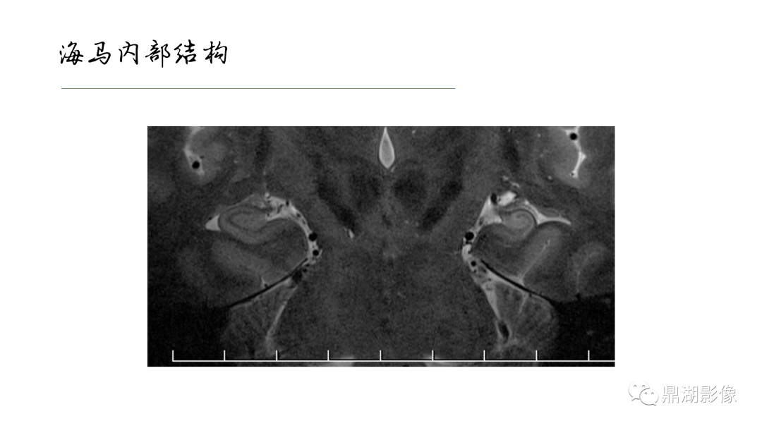 影像PPT - 【PPT】准确识别MR大脑解剖结构的诊断价值-46