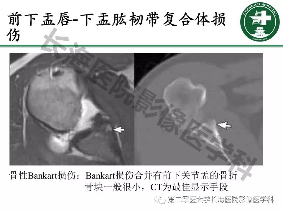 影像PPT - 【PPT】肩关节不稳影像表现-12