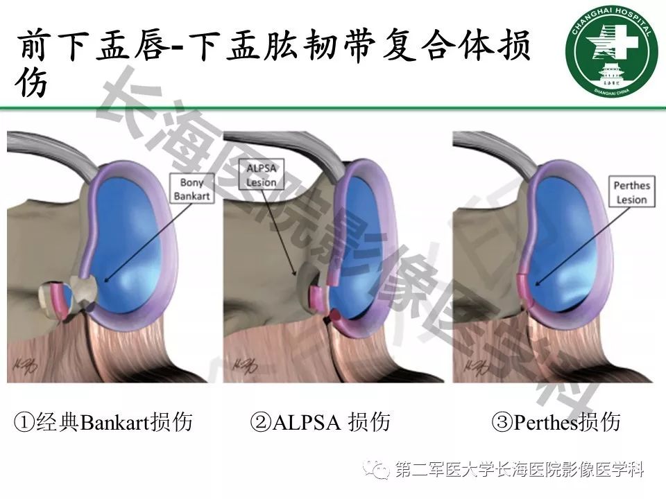 影像PPT - 【PPT】肩关节不稳影像表现-9