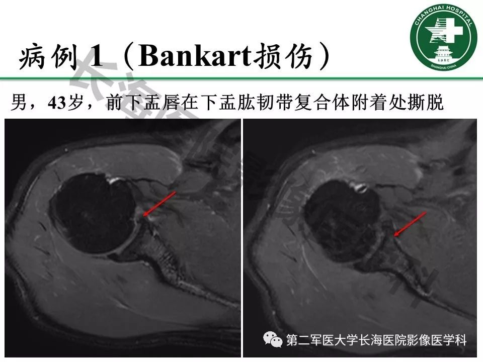 影像PPT - 【PPT】肩关节不稳影像表现-14